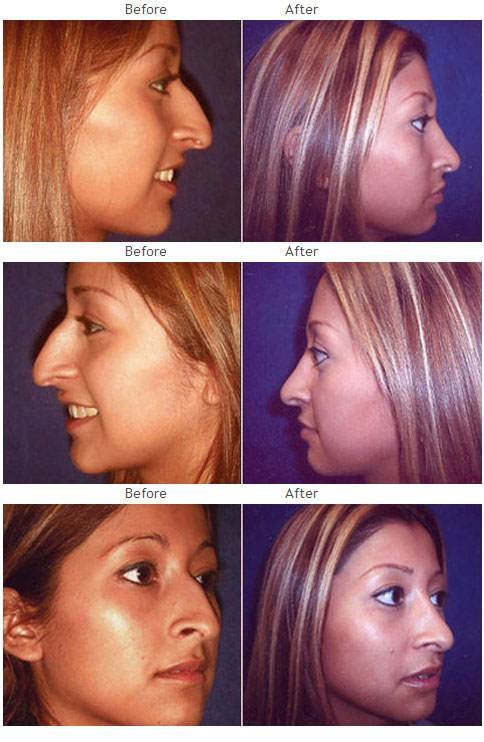 Rhinoplasty (Nose) before and after