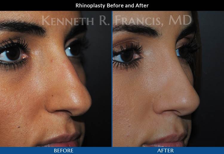 Rhinoplasty (Nose) before and after
