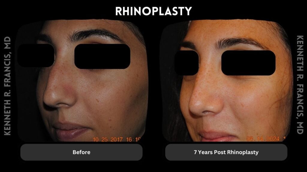 Rhinoplasty before and after 2 Rhinoplasty - 7 Years Post Surgery