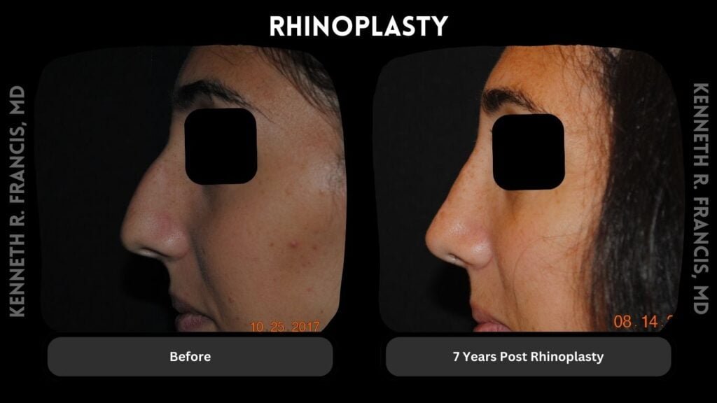 Rhinoplasty before and after 1 Rhinoplasty - 7 Years Post Surgery