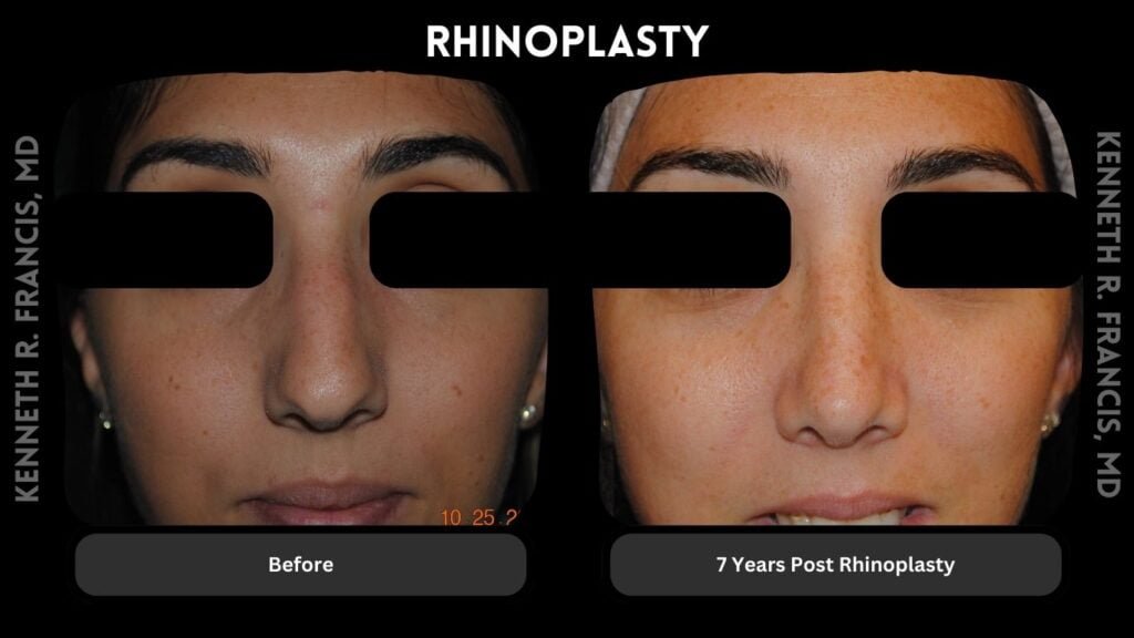 Rhinoplasty before and after 3 Rhinoplasty - 7 Years Post Surgery